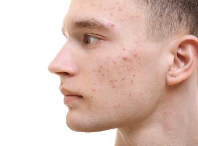man with facial acne