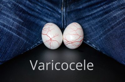 varicocele